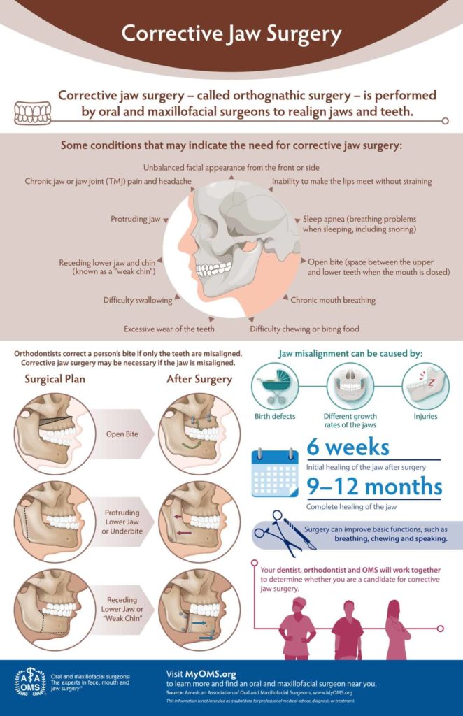 corrective jaw surgery